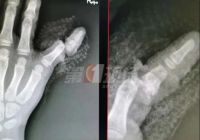 防不胜防，别让你家的柜门再吃人了！