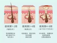 IAM冰点无痛脱毛仪震撼上市，10分钟轻松“脱全身”