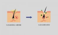 射频健发梳能让你居家就能轻松养发
