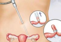 女人结扎了12年了还能接吗 结扎十二年还会怀孕吗