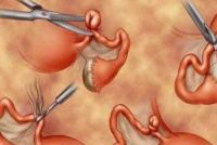 女人结扎了12年了还能接吗 结扎十二年还会怀孕吗